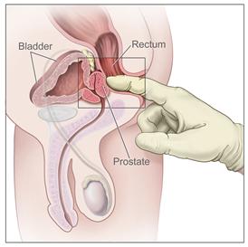 prostate_milking_diagram